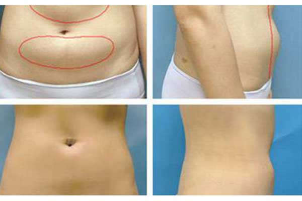 啤酒肚2.jpg 啤酒肚2.jpg